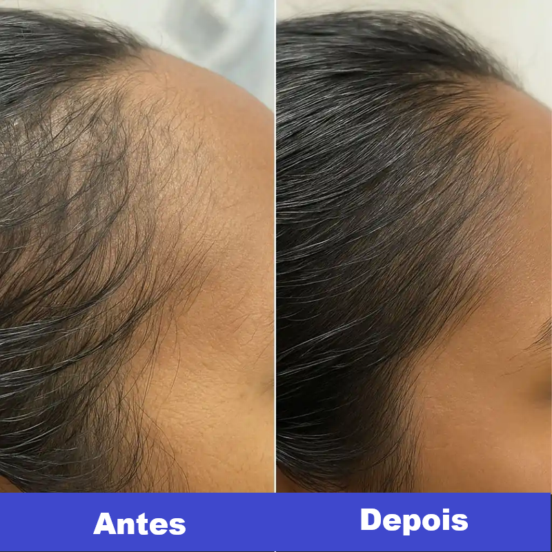 Escova LiviêLed | Saúde para seus Cabelos