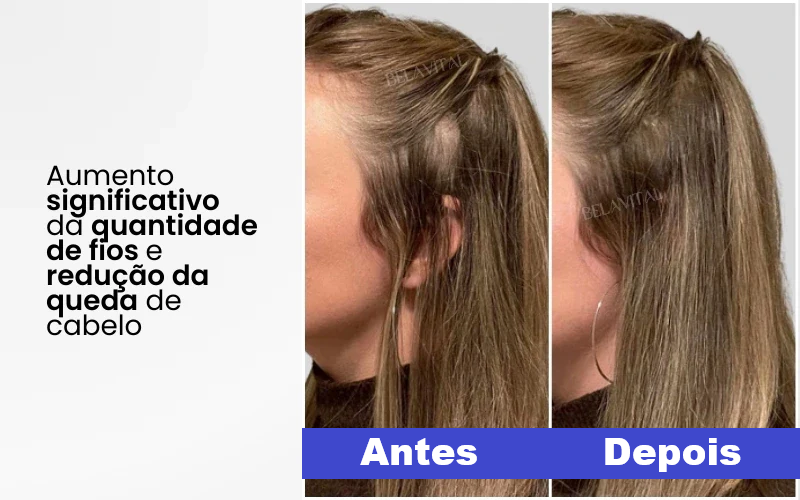 Escova LiviêLed | Saúde para seus Cabelos